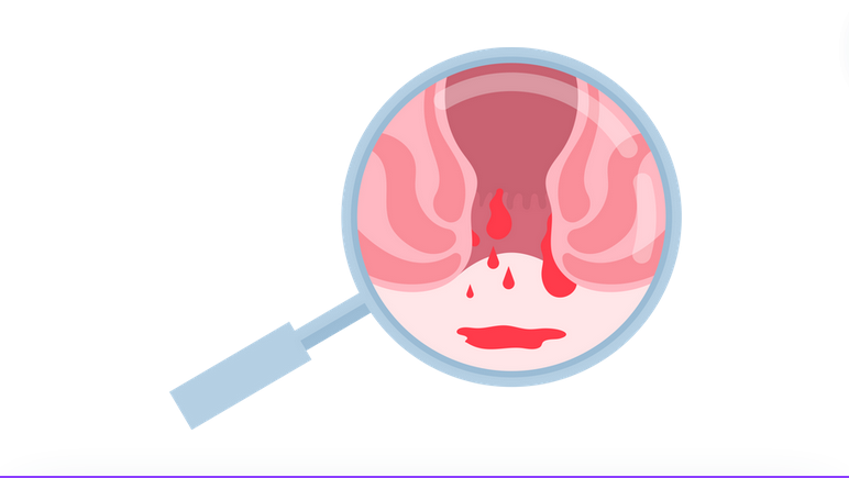 عمليه البواسير بالليزر