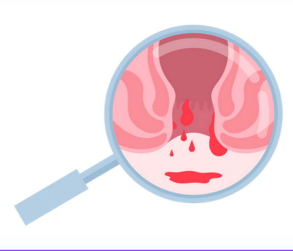 علاج البواسير نهائيا